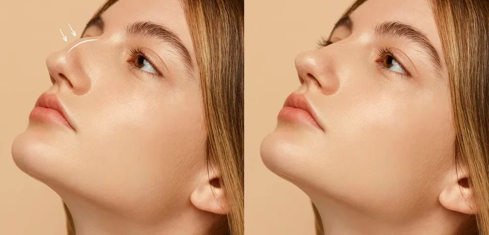 Nazolabial Dolgu: Burun Kenarı Çizgilerinden Kurtulun 11 Nazolabial Dolgu: Burun Kenarı Çizgilerinden Kurtulun