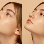 Nazolabial Dolgu: Burun Kenarı Çizgilerinden Kurtulun 9 Nazolabial Dolgu: Burun Kenarı Çizgilerinden Kurtulun