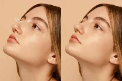 Nazolabial Dolgu: Burun Kenarı Çizgilerinden Kurtulun