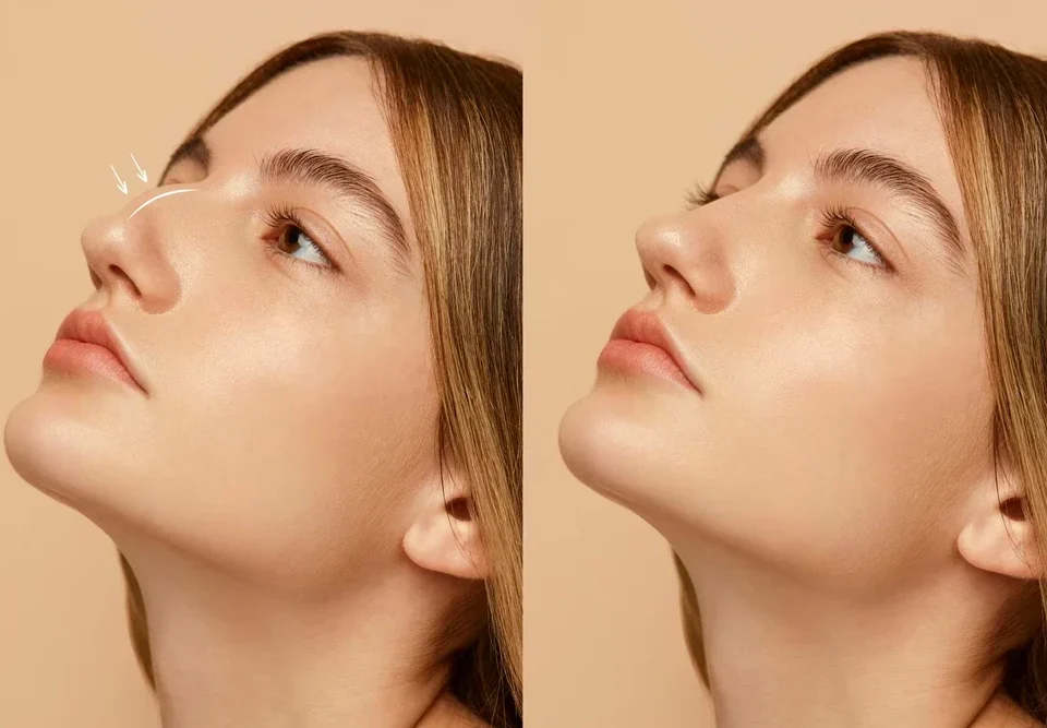 Nazolabial Dolgu: Burun Kenarı Çizgilerinden Kurtulun