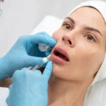 Dolgu Sonrası Şişlik ve Morluk: Normal mi ve Nasıl Geçer? 9 Dolgu Sonrası Şişlik ve Morluk: Normal mi ve Nasıl Geçer?