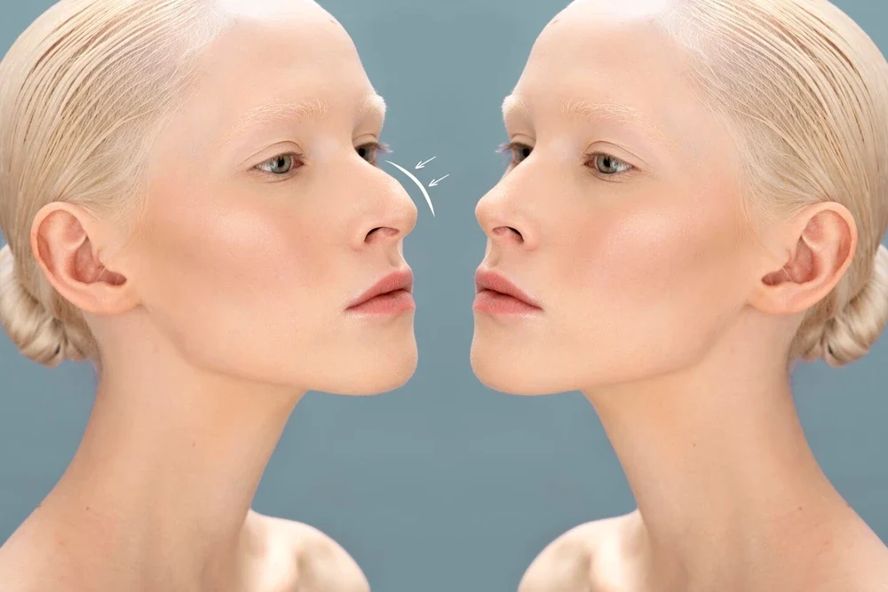 Nazolabial Dolgu: Burun Kenarı Çizgilerinden Kurtulun