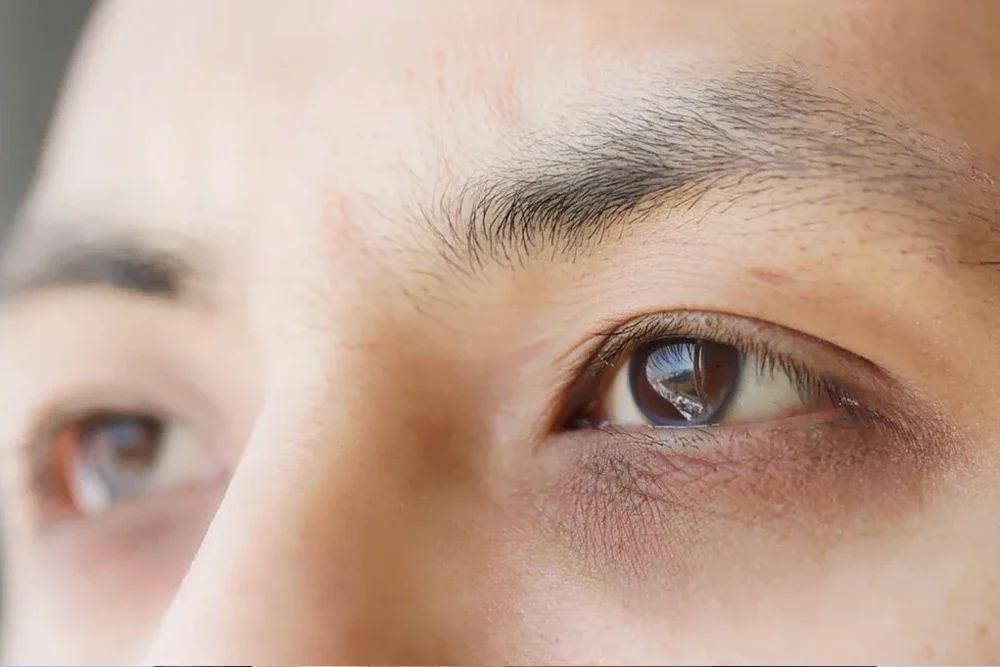 Which Application is Effective for Dark Circles Under the Eyes? | Dr. Melis Ülger
