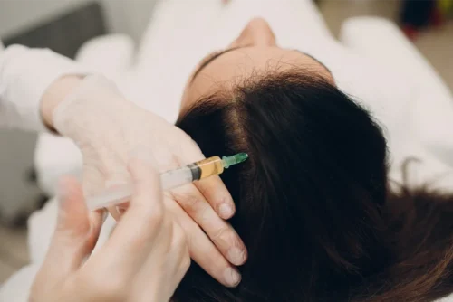 Hair Mesotherapy: Benefits, Application Areas and Things to Know