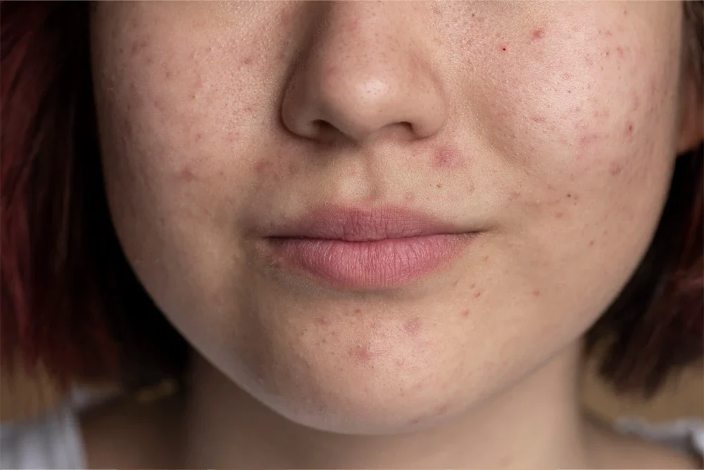 How to Remove Skin Blemishes? Mesotherapy and Other Solutions