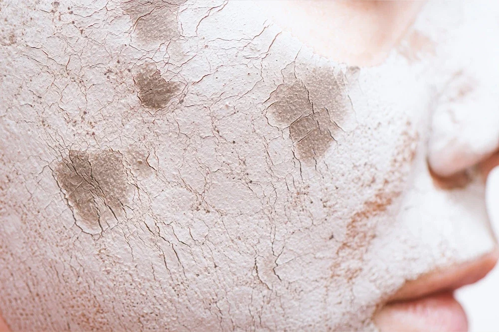 How to Remove Skin Blemishes? Mesotherapy and Other Solutions