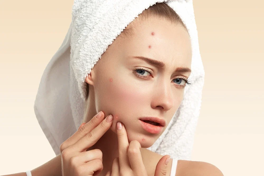 Akne ve Sivilce İzleri İçin Medikal Estetik Çözümleri: Pürüzsüz Bir Cilde Dönüş