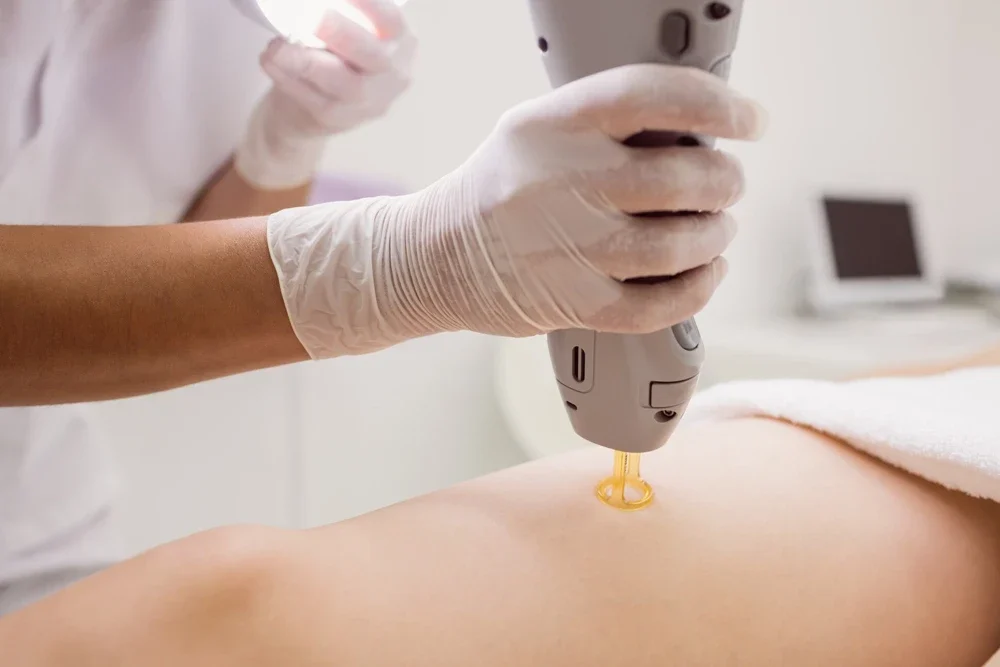 Tüm Vücut Lazer Epilasyon: Bilmeniz Gerekenler