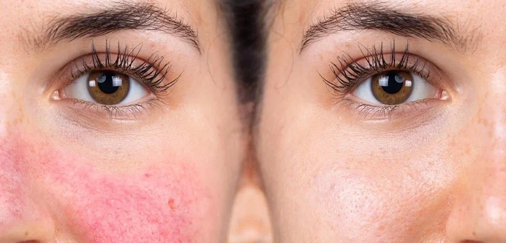 Medikal Estetik ile Rosacea (Gül Hastalığı) Tedavisi: Kızarıklığı Kontrol Altına Alın