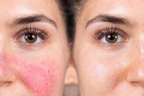 Medikal Estetik ile Rosacea (Gül Hastalığı) Tedavisi: Kızarıklığı Kontrol Altına Alın