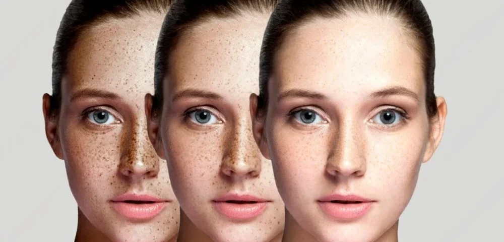 Medikal Estetik ile Cilt Tonu Eşitsizliği Tedavisi: Fondötensiz, Tek Renk Bir Cilt