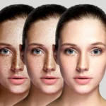 Medikal Estetik ile Cilt Tonu Eşitsizliği Tedavisi: Fondötensiz, Tek Renk Bir Cilt