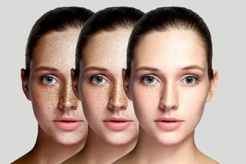 Medikal Estetik ile Cilt Tonu Eşitsizliği Tedavisi: Fondötensiz, Tek Renk Bir Cilt