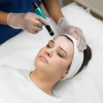 Hydrafacial ile Ciltteki Yağlanma Sorununa Çözüm: Parlamadan Arınmış, Sağlıklı Bir Cilt