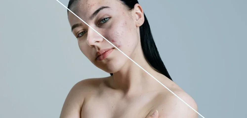 Medikal Estetik ile Ciltteki Gözenekleri Sıkılaştırma: Porselen Gibi Pürüzsüz Bir Cilt 11 Medikal Estetik ile Ciltteki Gözenekleri Sıkılaştırma: Porselen Gibi Pürüzsüz Bir Cilt