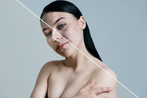 Medikal Estetik ile Ciltteki Gözenekleri Sıkılaştırma: Porselen Gibi Pürüzsüz Bir Cilt