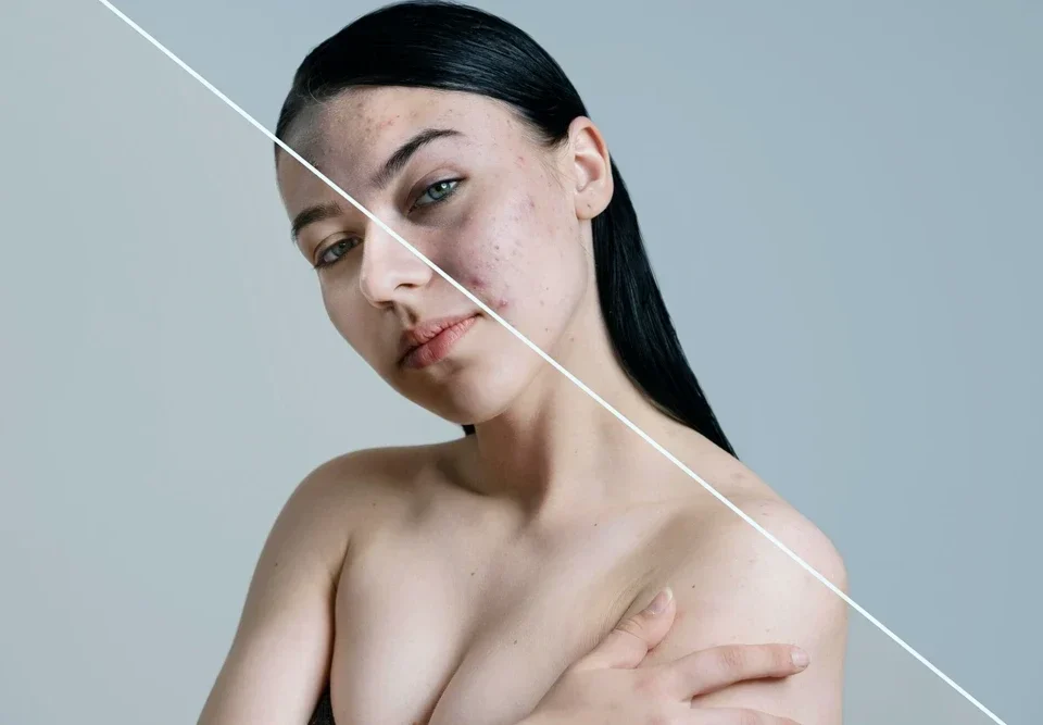 Medikal Estetik ile Ciltteki Gözenekleri Sıkılaştırma: Porselen Gibi Pürüzsüz Bir Cilt