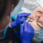 Dermal Dolgu ile Yüz Germe Etkisi Yaratmak (Sıvı Yüz Germe): Ameliyatsız Gençleşme 9 Dermal Dolgu ile Yüz Germe Etkisi Yaratmak (Sıvı Yüz Germe): Ameliyatsız Gençleşme