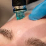 Hydrafacial Zararları Var mı? 5 Gerçek Yanıt