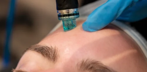 Hydrafacial Zararları Var mı? 5 Gerçek Yanıt