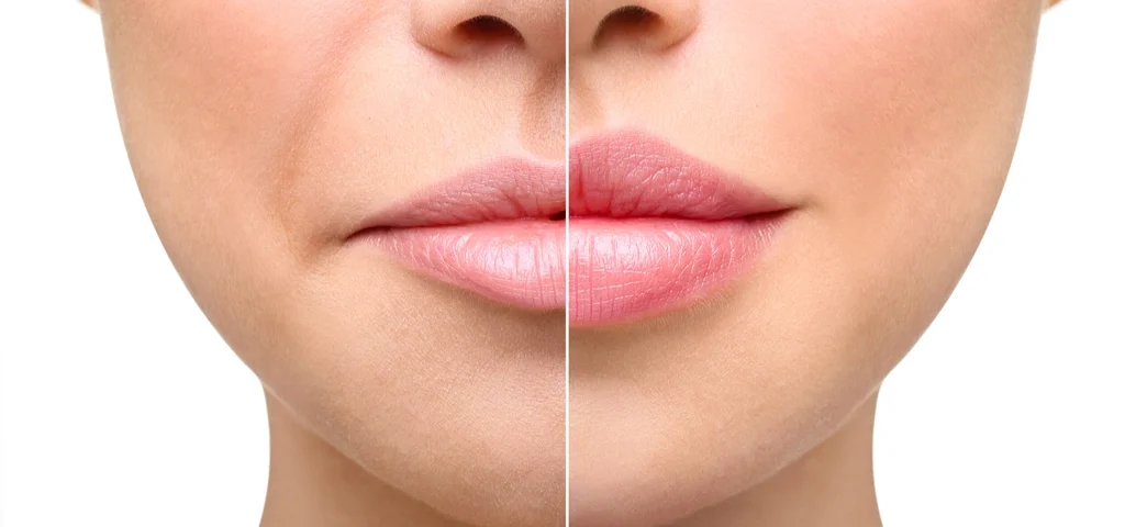 Lipstick After Lip Fillers: The 3-Day Rule