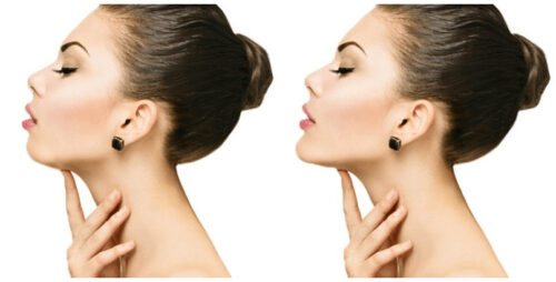 What Is Jawline Filler? A 2026 Guide to Jawline Enhancement