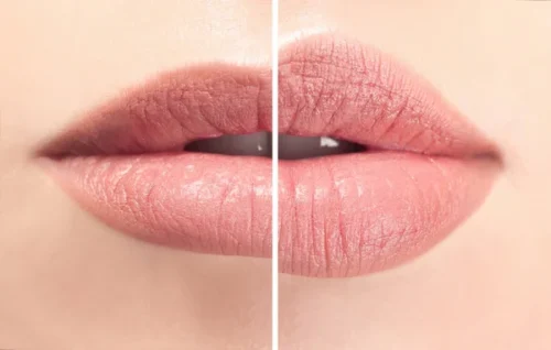 Lip Botox (Lip Flip): 2026 Plump Lips Without Fillers