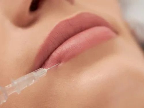 Lip Filler Dissolution: The 2026 Hyaluronidase Guide