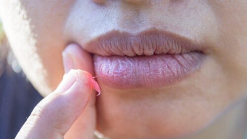 Lumpiness in Lip Fillers: 5 Causes and Solutions