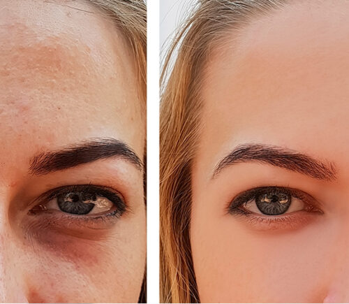 Under-Eye Filler: The 2026 Solution for Dark Circles and Hollows