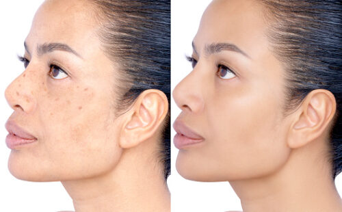 Melasma Treatment: 2026 Solutions for Stubborn Dark Spots