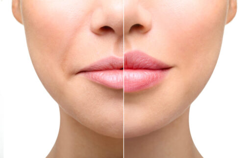 Before and After Nasolabial Filler: 2026 Results