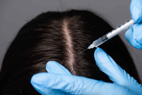 Hair Mesotherapy: A 2026 Guide to Combating Hair Loss