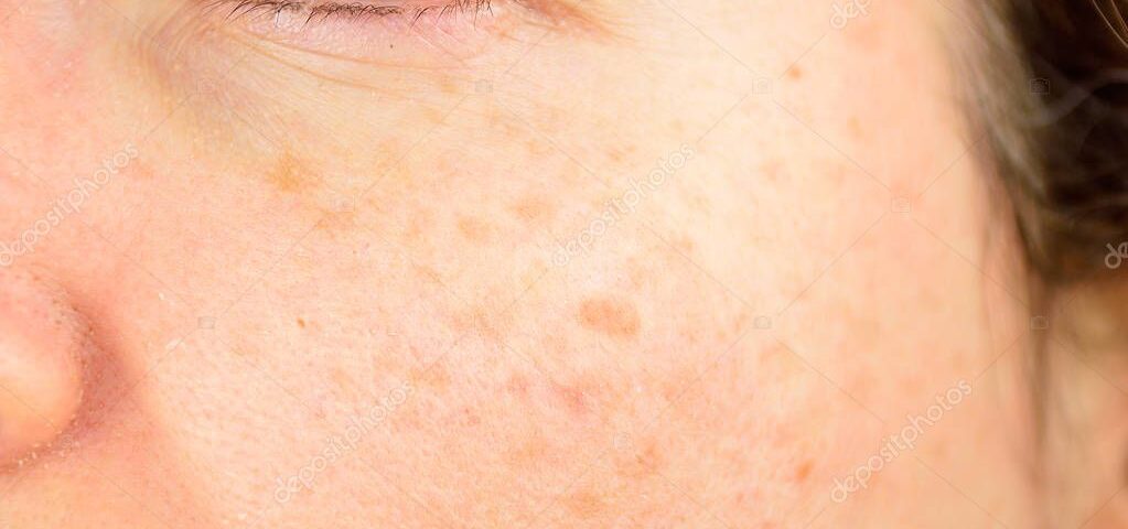 How to Get Rid of Skin Stains: 5 Methods and a 2026 Guide