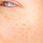 How to Get Rid of Skin Stains? 5 Methods and the 2026 Guide 6 How to Get Rid of Skin Stains: 5 Methods and a 2026 Guide