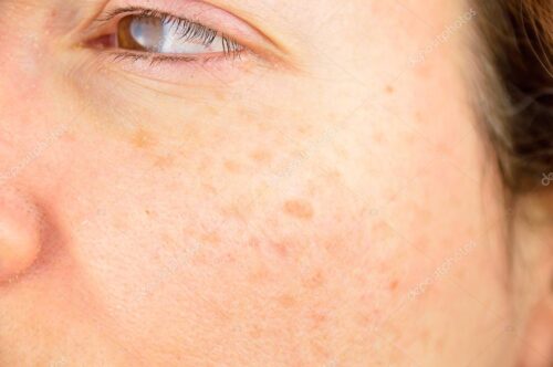 How to Get Rid of Skin Stains: 5 Methods and a 2026 Guide