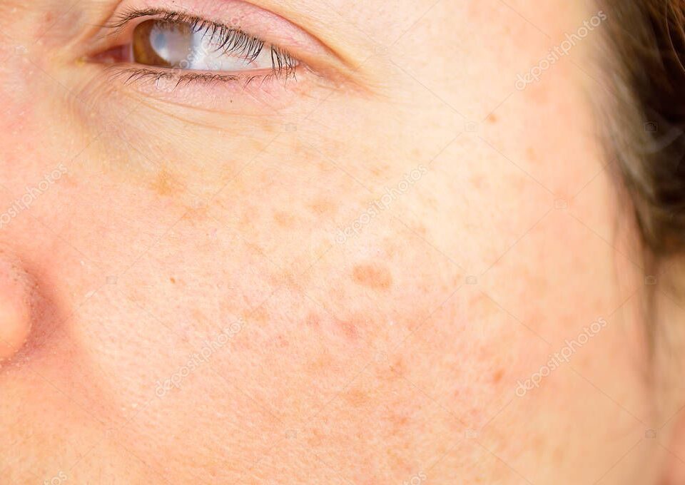 How to Get Rid of Skin Stains: 5 Methods and a 2026 Guide
