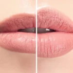 Dudak Dolgusu Zararları: 6 Risk ve Gerçekler (2026) 4 Risks of Lip Fillers: 6 Risks and Facts (2026)