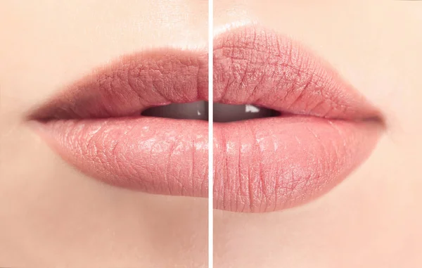 Dudak Dolgusu Zararları: 6 Risk ve Gerçekler (2026) 11 Risks of Lip Fillers: 6 Risks and Facts (2026)