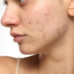 Acne Scar Treatment: 2026 Solutions for Acne Scars
