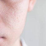 Hydrafacial mı Karbon Peeling mi? 2026 Karşılaştırma
