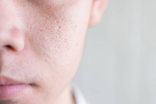HydraFacial or Carbon Peel? A 2026 Comparison