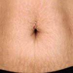 Melasma: What Causes the "Pregnancy Mask"? (2026)