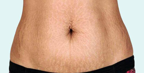Melasma: What Causes the "Pregnancy Mask"? (2026)