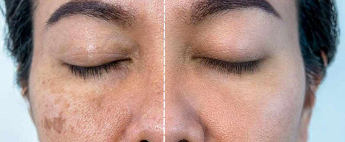 Before and After Mesotherapy: 2026 Results and Process 7 Before and After Mesotherapy: 2026 Results and Process