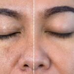 Before and After Mesotherapy: 2026 Results and Process