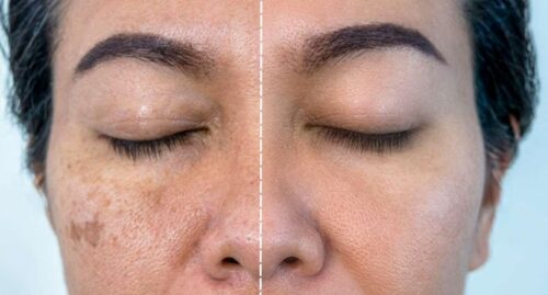 Before and After Mesotherapy: 2026 Results and Process